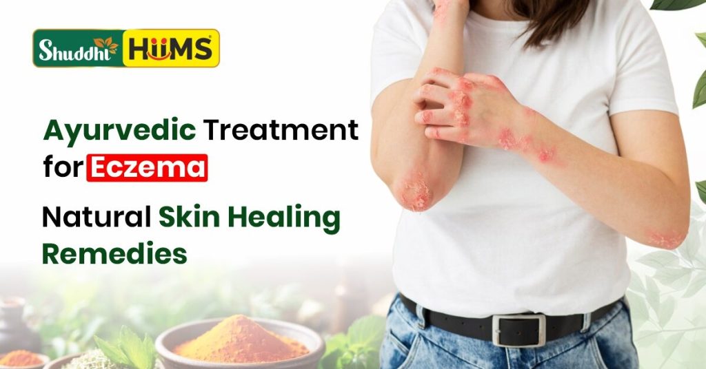 Ayurvedic Treatment for Eczema